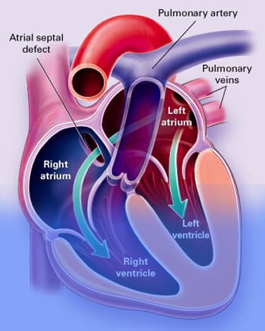 Heart Transplantation