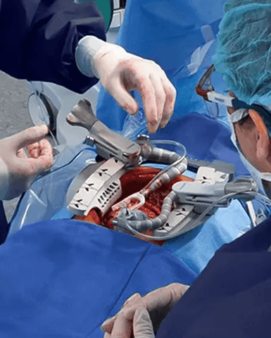 Beating Heart Surgery